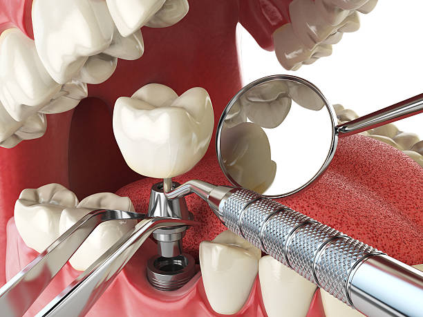 Best Lost Filling or Crown Replacement in Milliken, CO